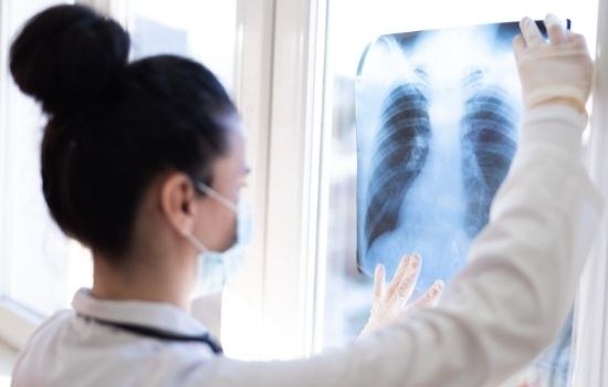 lung cancer doctor reviewing lung scan for cancer detection