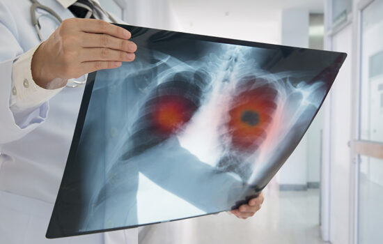 11 Surprising Signs of Lung Cancer You Need to Know