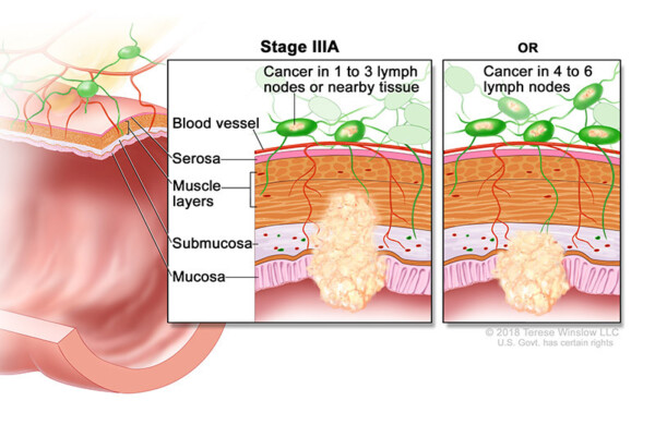 colorectal cancer stage 3a