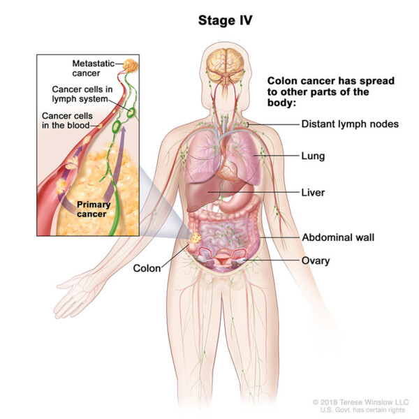 colorectal cancer stage 4