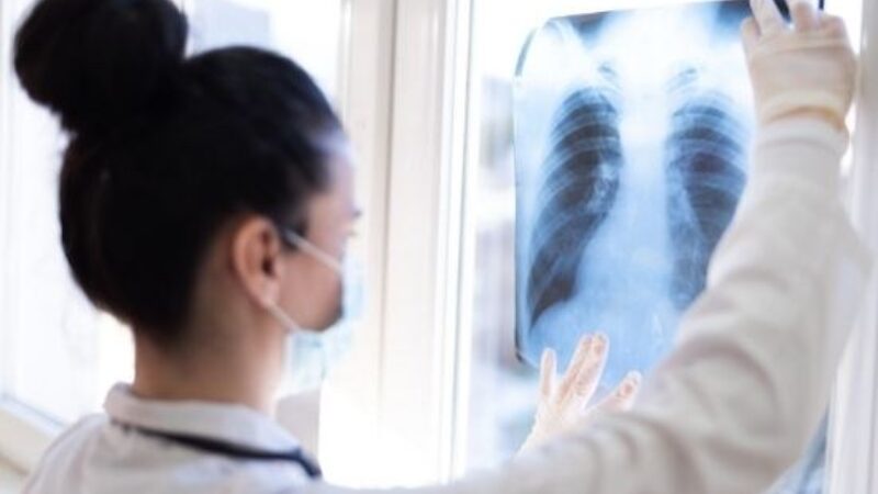 Should I Be Screened for Lung Cancer?