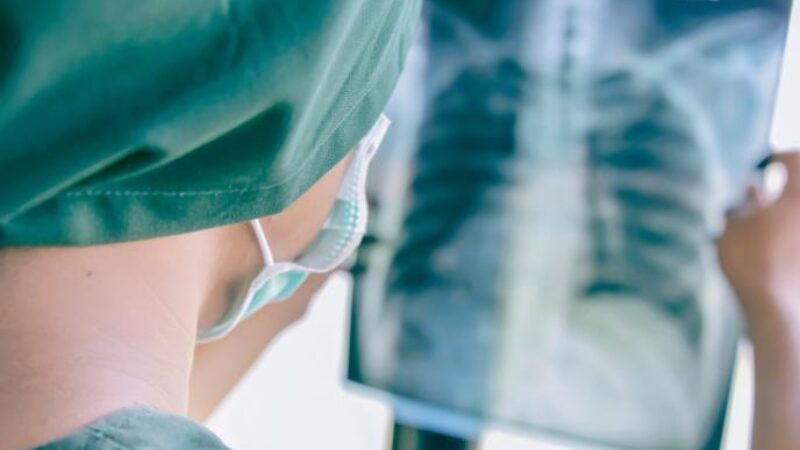 What to Expect If You Have Lung Cancer Surgery