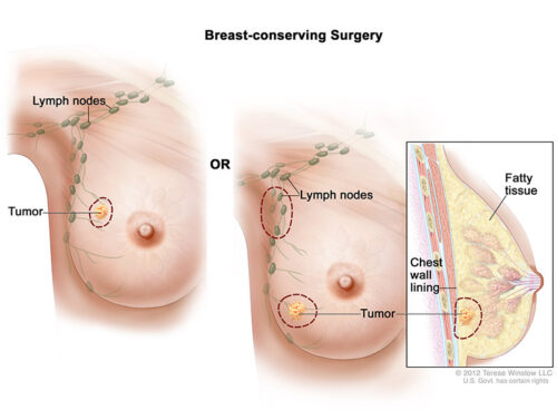 breast-sparing surgery