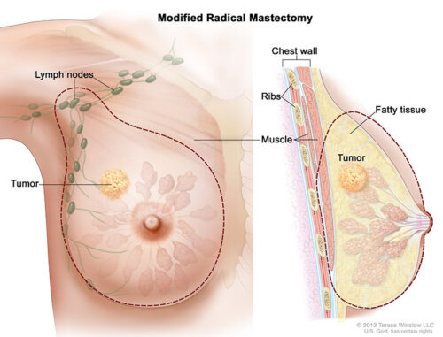 modified radical mastectomy