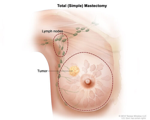 total mastectomy