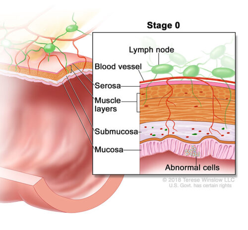 colorectal cancer stage 0