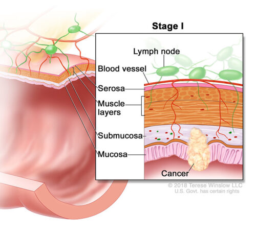 colorectal cancer stage 1