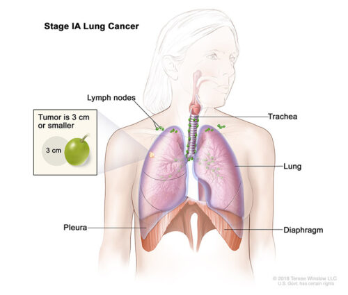 lung cancer stage 1a