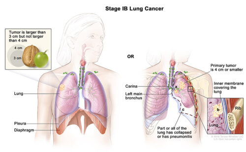 lung cancer stage 1b