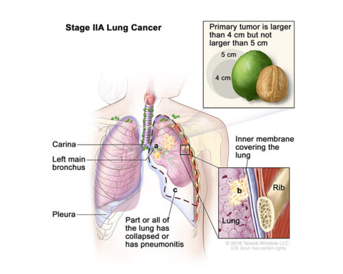 lung cancer stage 2a