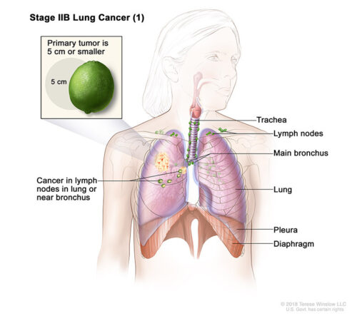 lung cancer stage 2b