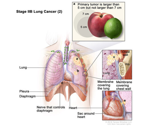 lung cancer stage 2b2