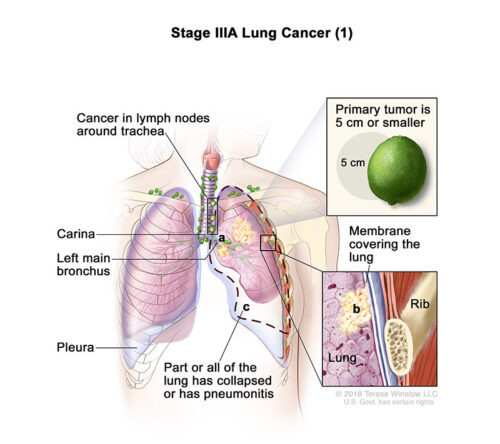 lung cancer stage 3a1
