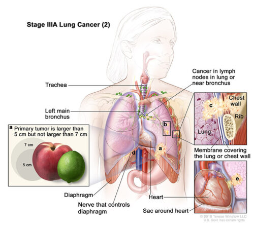 stage 3a2 lung cancer