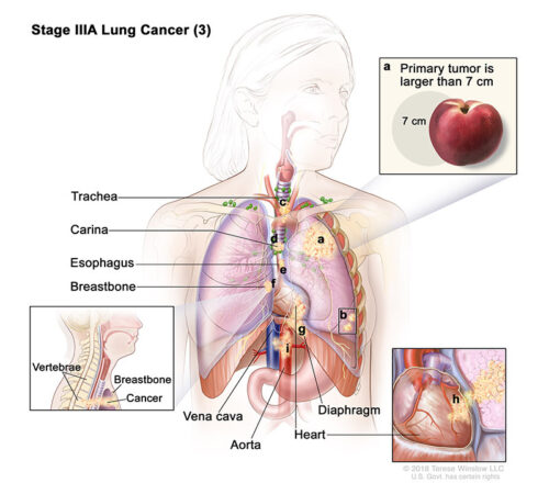 lung cancer stage 3a part 3
