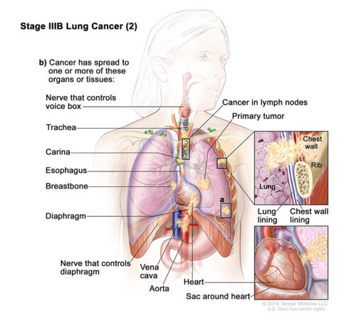 lung cancer stage3b part2