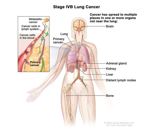 lung cancer stage 4b