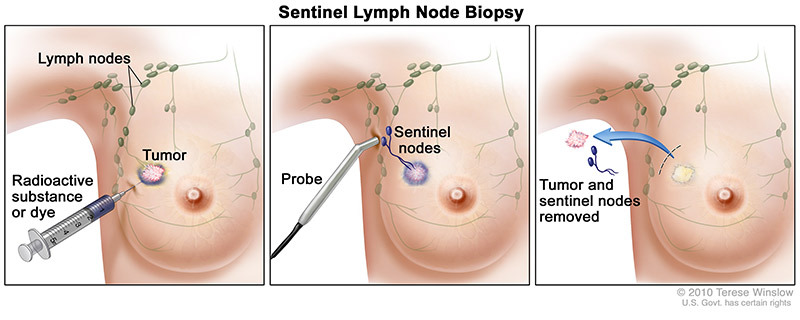 Sentinel Lymph Node Biopsy