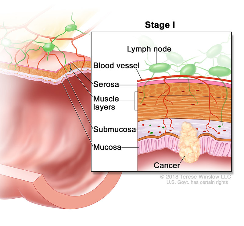 colorectal cancer stage 1