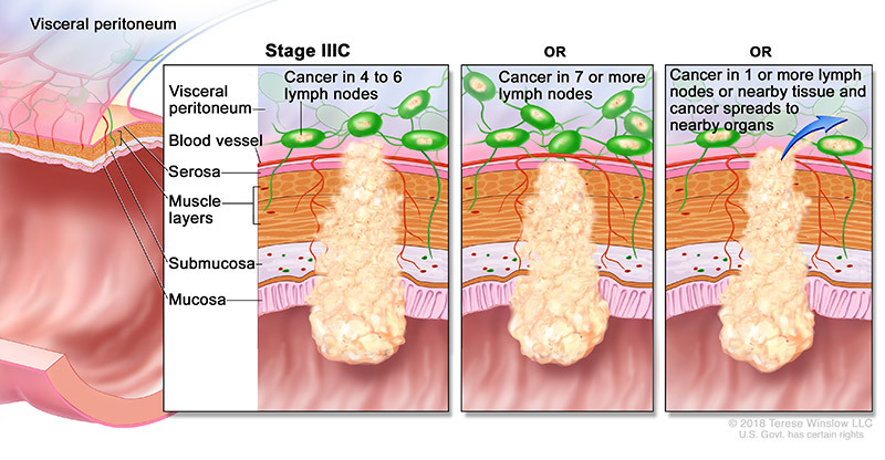 colorectal cancer stage 3c
