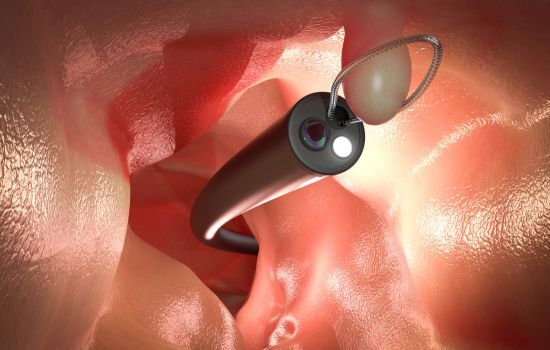 what to do if polyps are found during a colonoscopy