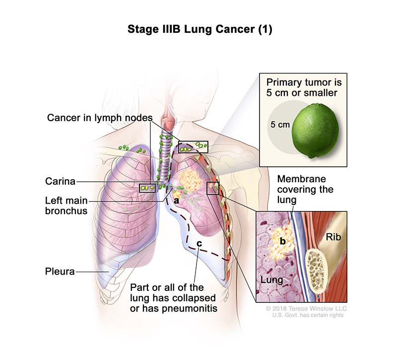 lung cancer stage3b part 1