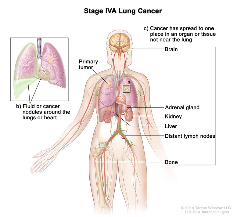 lung cancer stage 4a