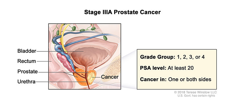 Prostate Cancer Stage IIIA