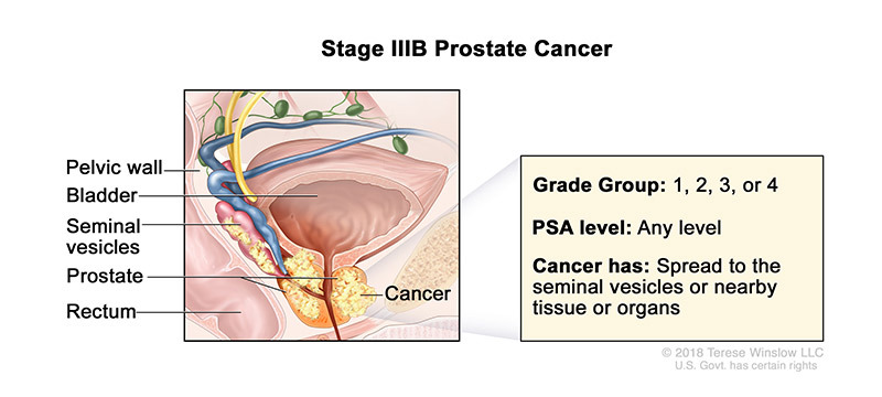 Prostate Cancer Stage IIIB